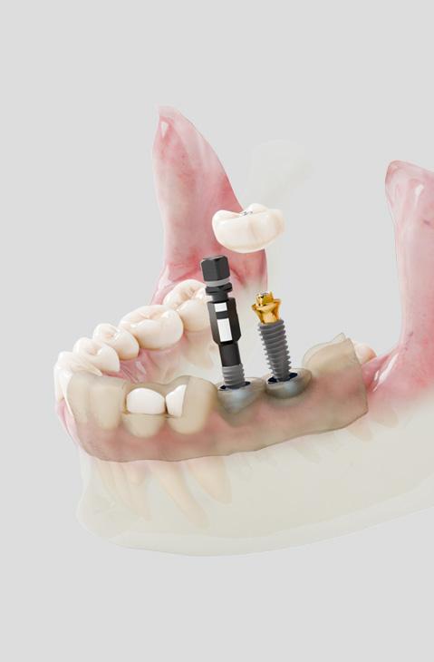 數位導引微創植牙系統