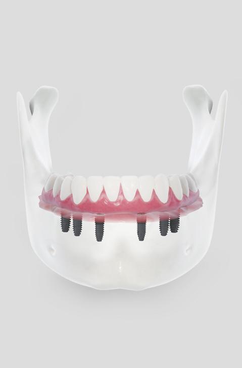 全口重建解決方案