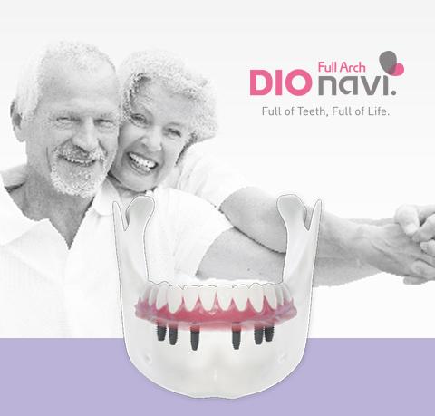 DIOnavi. Full Arch Leaflet for Patients